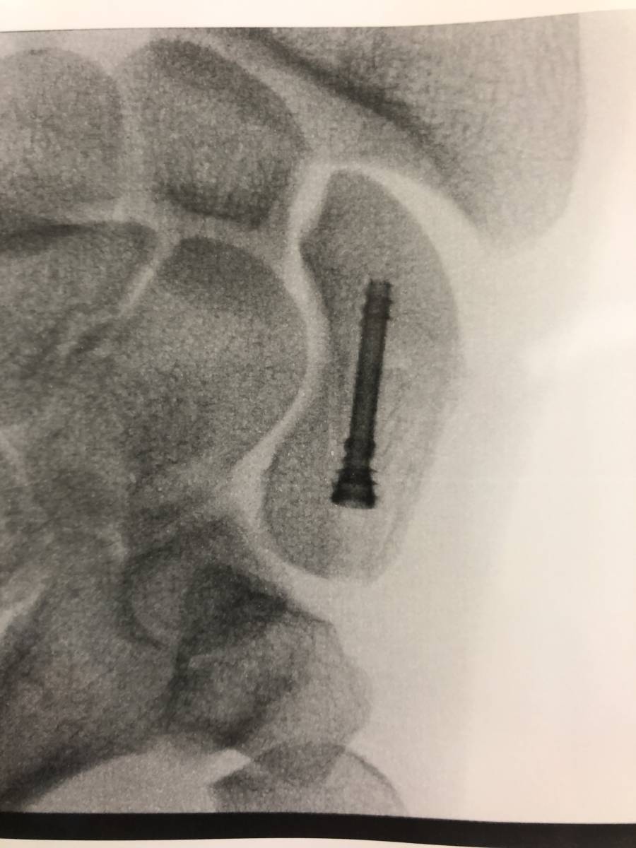 La fracture du scaphoide